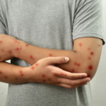 Brasil registra 88 casos de Mpox em 2026; saiba como evitar a doença
