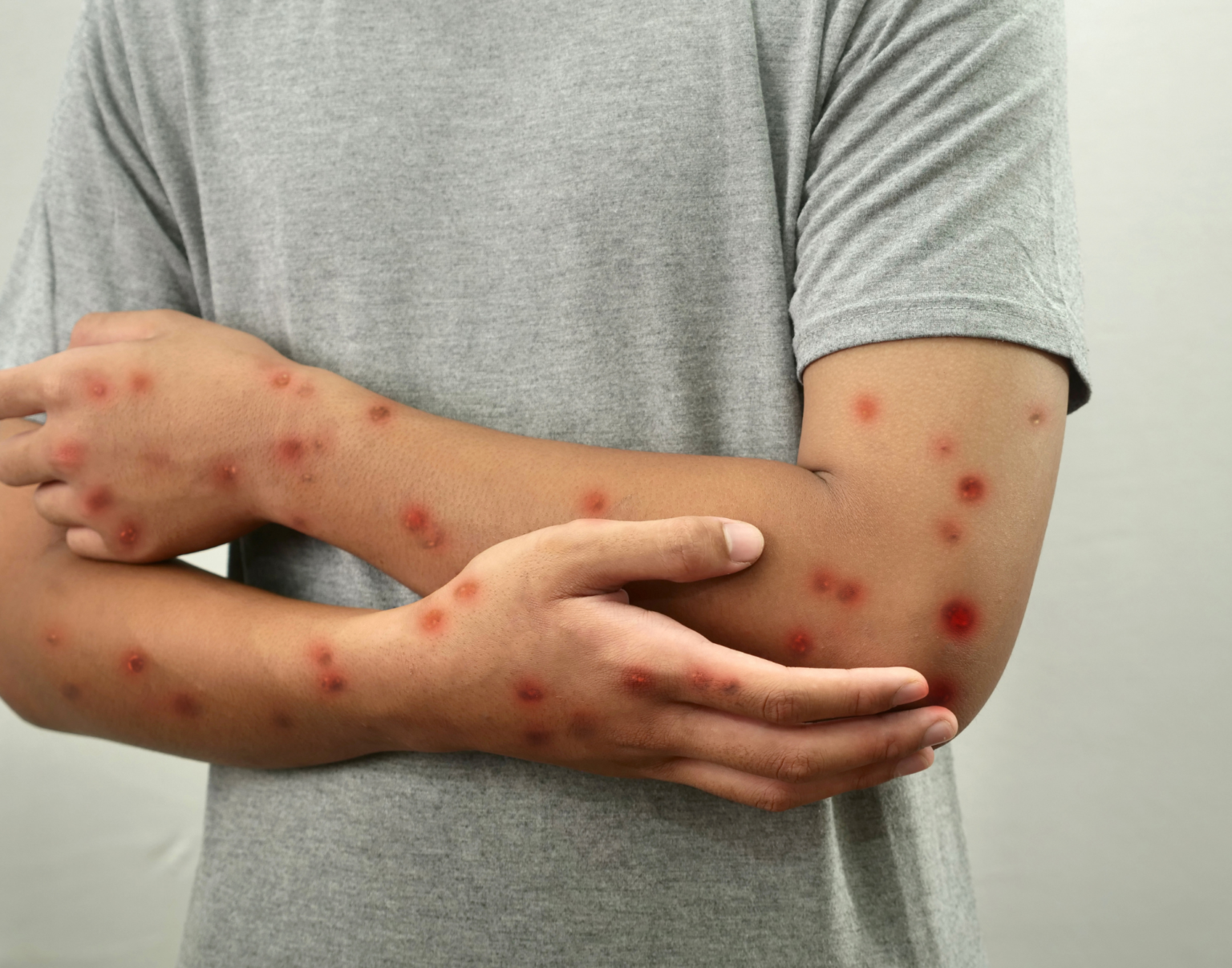 Brasil registra 88 casos de Mpox em 2026; saiba como evitar a doença