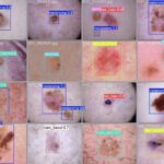 Aluna da Unipampa desenvolve modelo de Inteligência Artificial para apoiar diagnóstico de câncer de pele